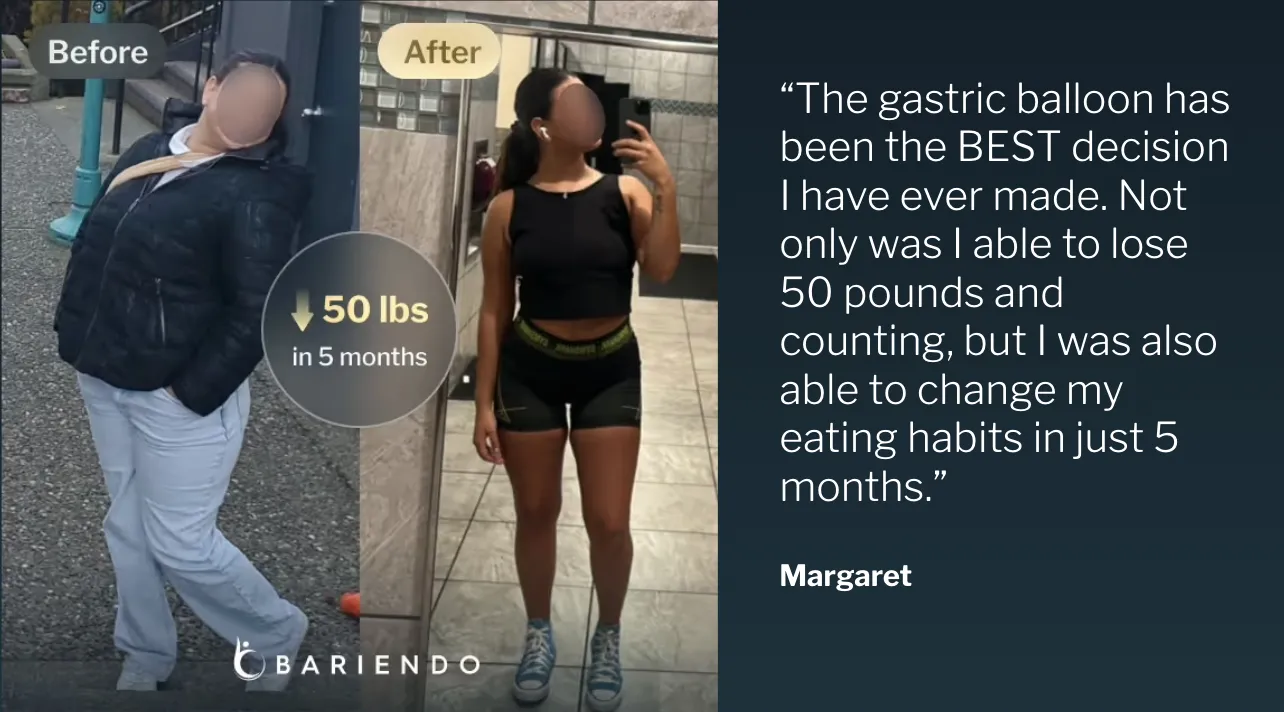 Before and after photo of gastric balloon patient Margaret who lost 50 lbs