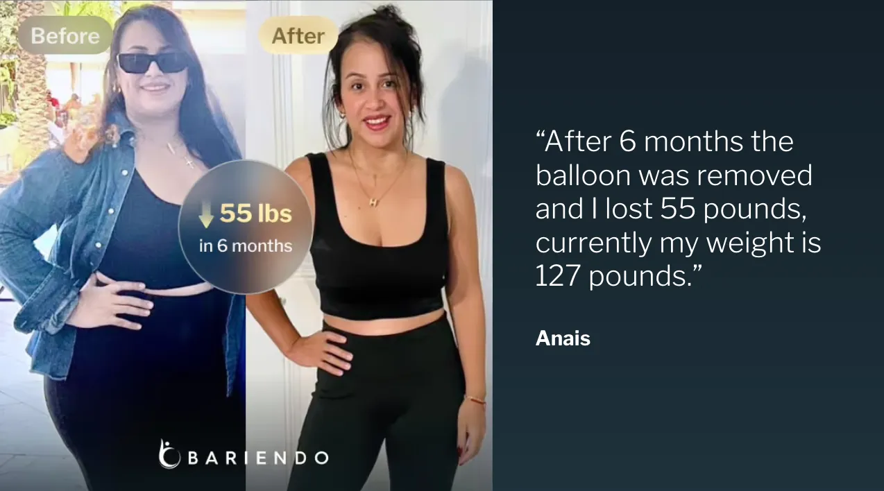 Before and after photos of gastric balloon patient Anais who lost 55 lbs