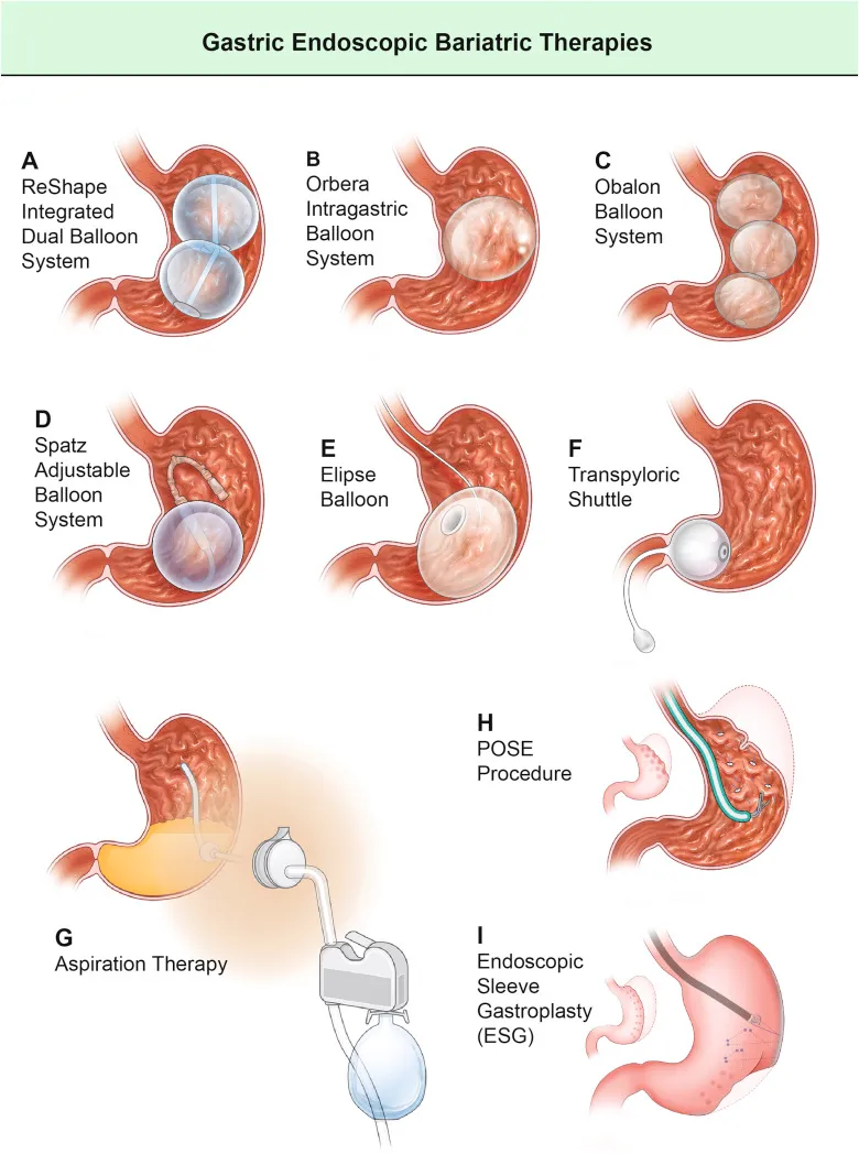 Gastric endoscopic bariatric therapies