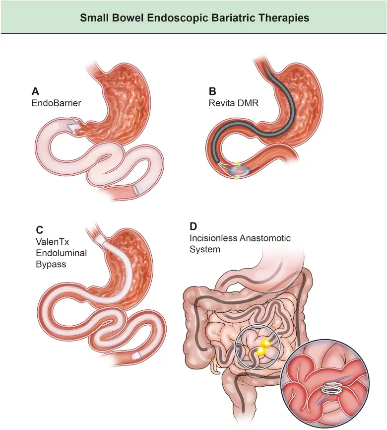Small bowel endoscopic bariatric therapies