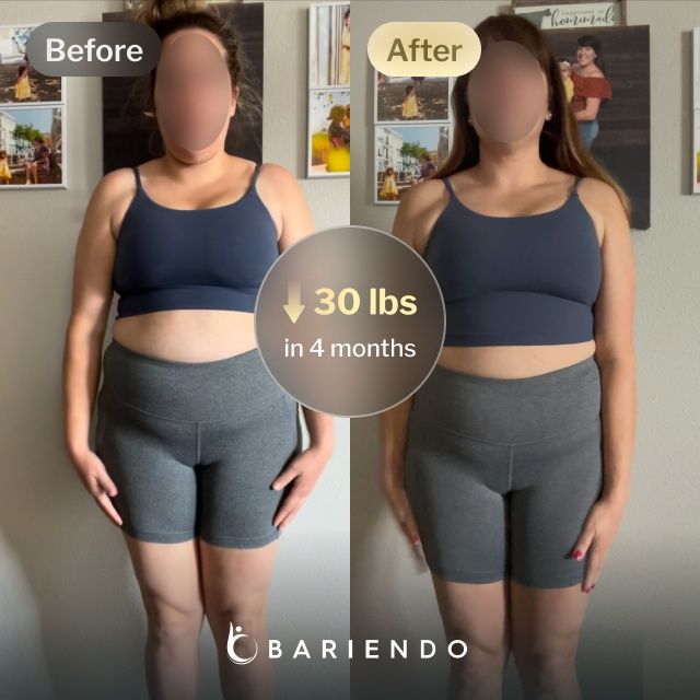 Before and after images of Iris who lost 30 pounds in 4 months after a Gastric Balloon procedure with Bariendo