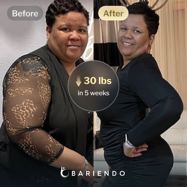 Before and after images of Gwendolyn who lost 30 pounds in 5 weeks after an ESG procedure