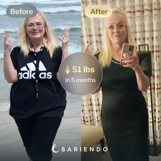 Before and after images of Jackie who lost 51 pounds in 5 months after a TORe procedure with Bariendo