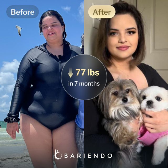 Before and after images of Nicole, a Bariendo ESG Stomach Tightening™ patient who lose 77 pounds in 7 months