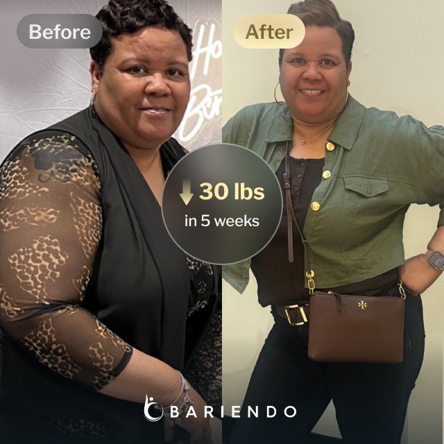 Before and after images of Gwendolyn who lost 30 pounds in 5 weeks after an ESG procedure