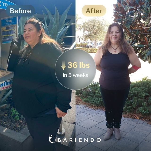 Before and after images of Doris who lost 36 pounds in 5 weeks after a ESG procedure with Bariendo