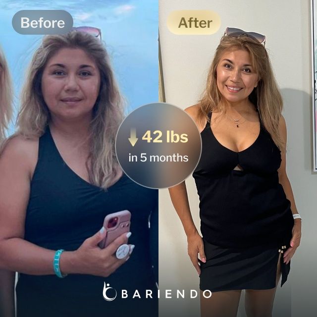 Before and after images of Amelia who lost 42 pounds in 5 months after a ESG procedure with Bariendo