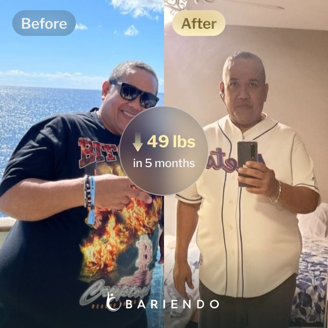 Before and after images of Cesar who lost 49 pounds in 5 months through Bariendo's ESG Stomach Tightening™ procedure