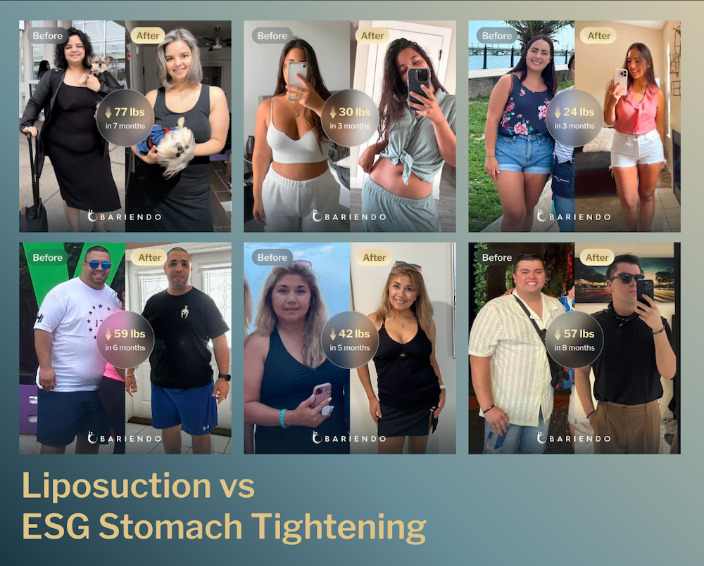 Before and after photos of ESG stomach tightening patients