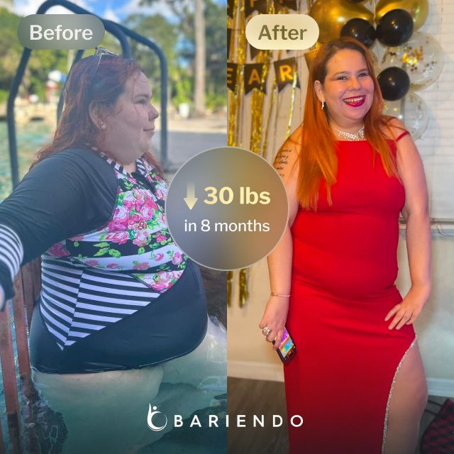 Before and after images of Isola who lost 30 pounds in 8 months after a Gastric Balloon procedure with Bariendo