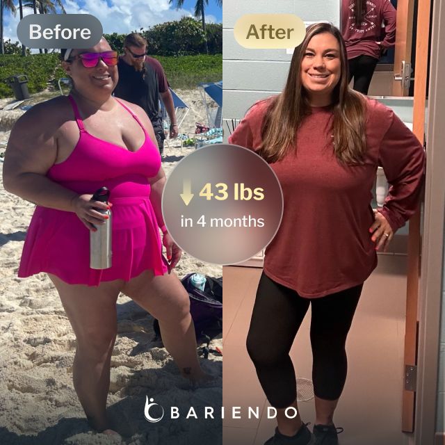 Before and after images of Mindi who lost 43 pounds in 4 months through Bariendo's non-surgical revision procedure