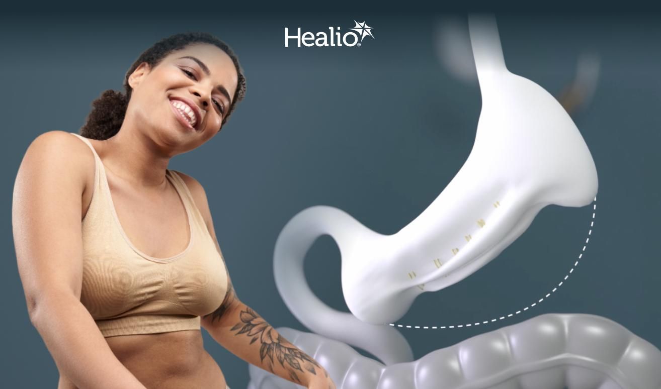 a smiling woman next to an illustrated model of an endoscopic sleeve gastroplasty (ESG) procedure