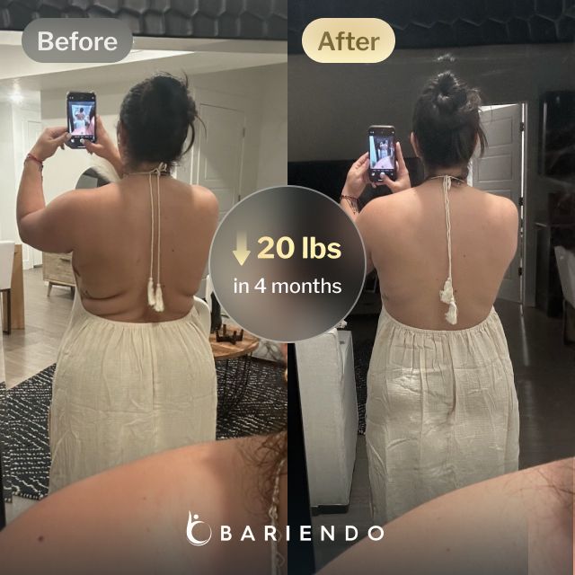Before and after image of Ruxibeth who lost 20 pounds in 4 months with a gastric balloon procedure