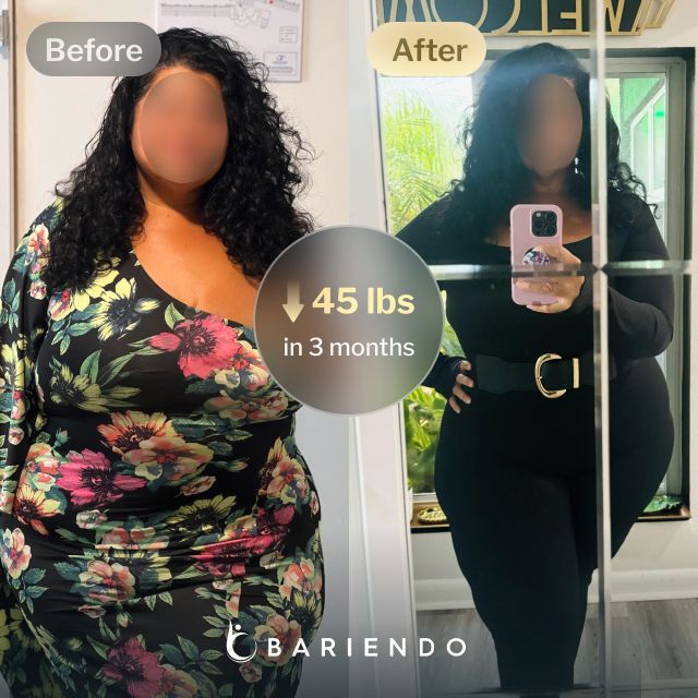 Before and after images of Erin who lost 45 pounds in 3 months after a Revision of Sleeve Gastrectomy Procedure - SIS with Bariendo