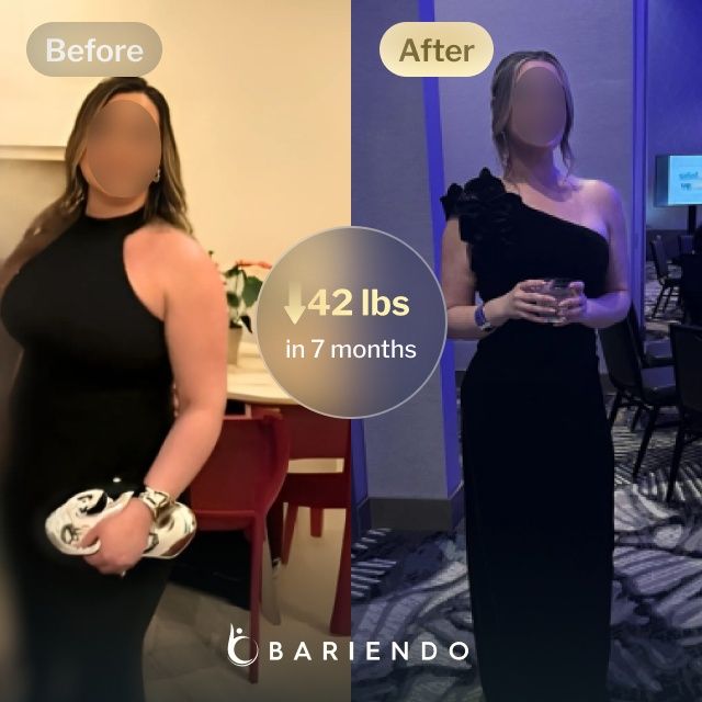 Before and after images of Natalie who lost 42 pounds in 7 months after a ESG procedure with Bariendo