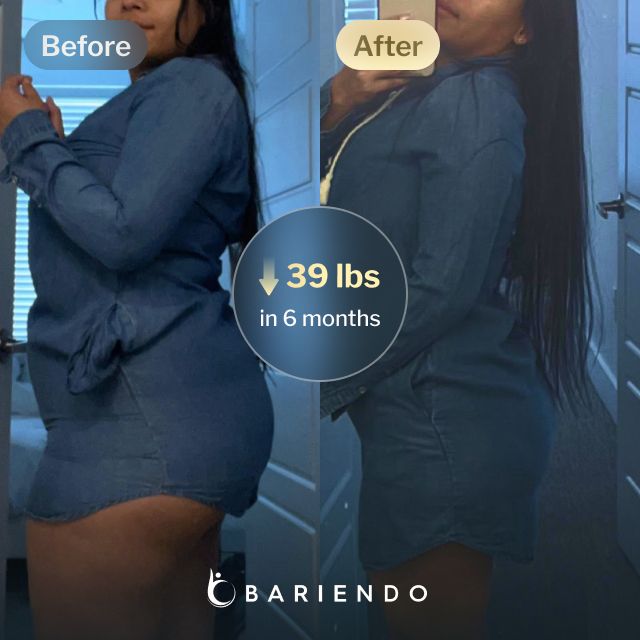 Before and after images of Daniela who lost 39 pounds in 6 months after a Gastric Balloon procedure with Bariendo