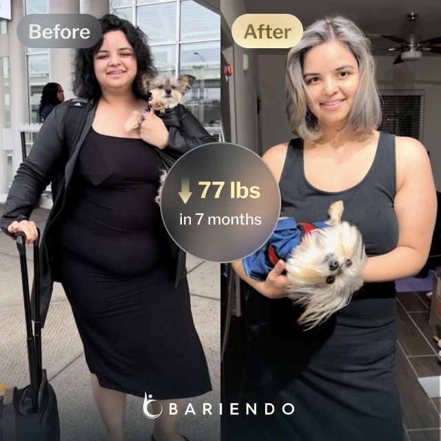 Before and after images of Nicole, a Bariendo ESG Stomach Tightening™ patient who lose 77 pounds in 7 months
