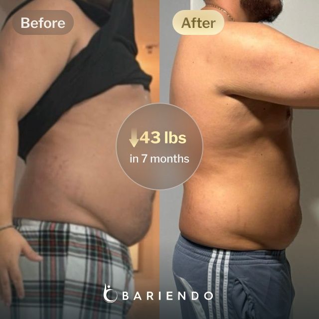 Before and after images of Juan who lost 43 pounds in 7 months after a Gastric Balloon procedure with Bariendo