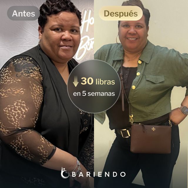 Imágenes de antes y después de Gwendolyn que perdió 30 libras en 5 semanas después de un procedimiento ESG