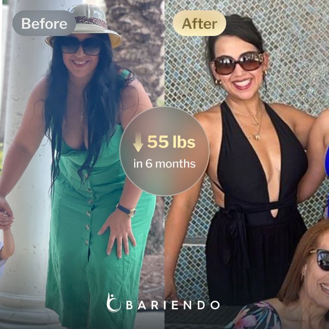 Before and after images of Anais who lost 55 pounds in 6 months after a Gastric Balloon procedure with Bariendo