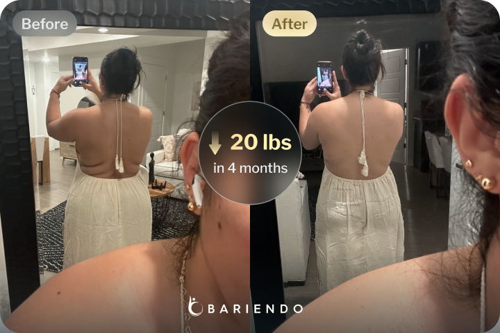 Gastric Balloon patient Success Story
